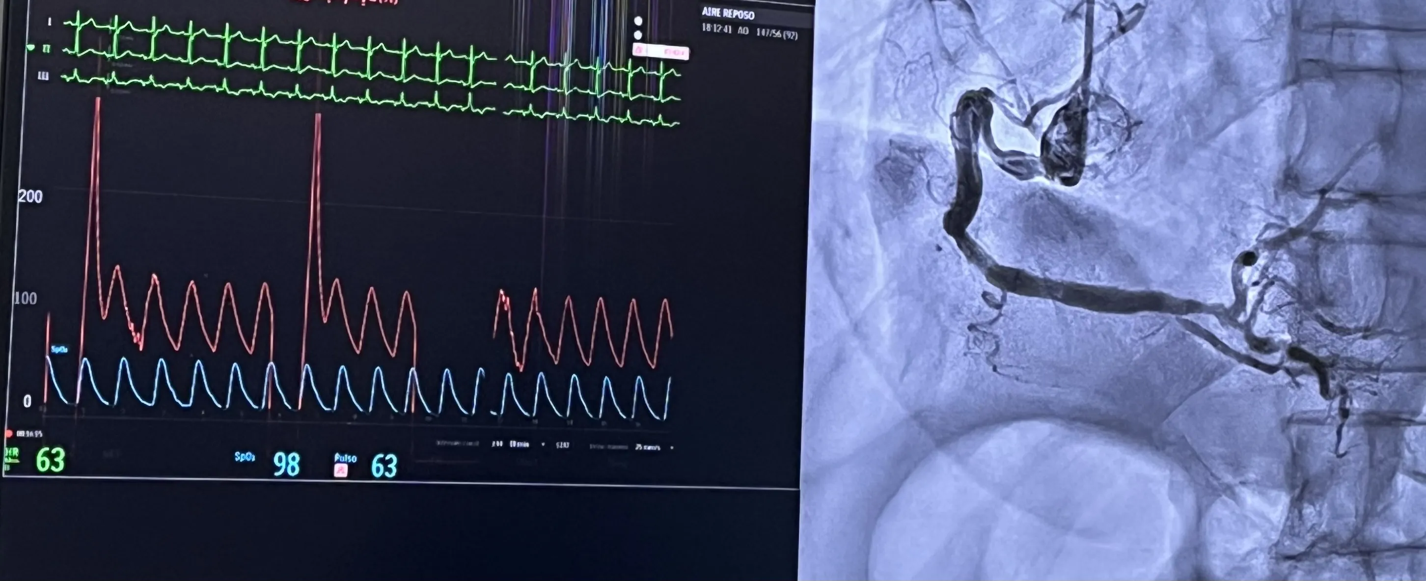 Angioplastia coronaria: explicación práctica y tipos de balones