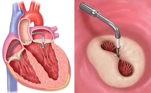Clip Mitral: Procedimiento, Técnica y Cuidados de Enfermería