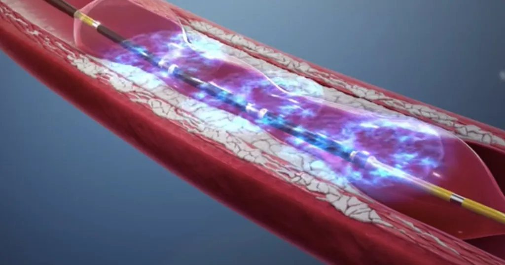 Litotricia Coronaria en Placas Calcificadas: Explicación Sencilla