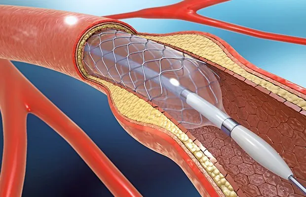 Stents Coronarios: Elección Adecuada y Papel de la Enfermería