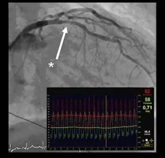Guía de presión hemodinámica en la unidad de hemodinámica