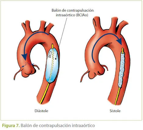 Balón de contrapulsación intraaórtico: soporte hemodinámico esencial