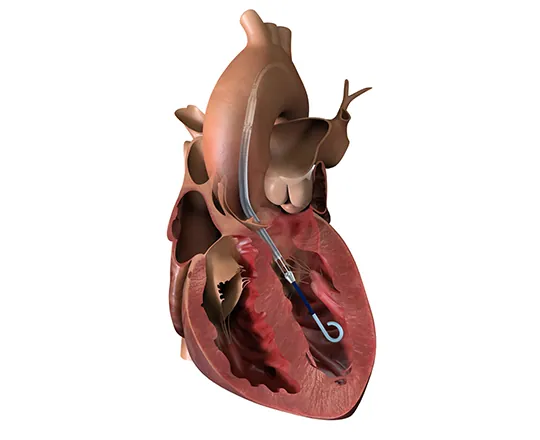 Asistencia ventricular Impella: qué es, indicaciones y cuidados