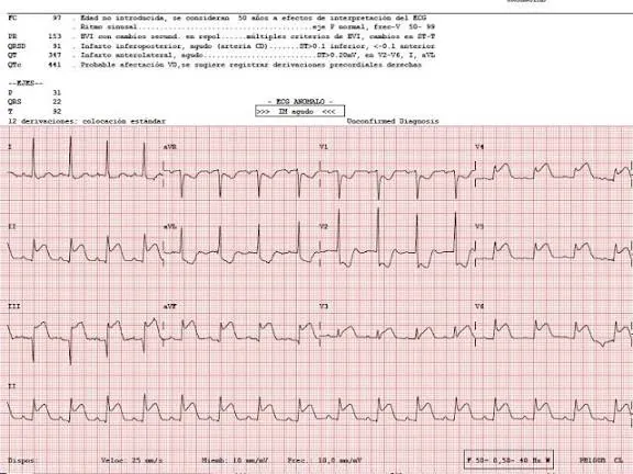 Caso Real: SCACEST Killip I: Del Dolor Torácico al Cateterismo Exitoso
