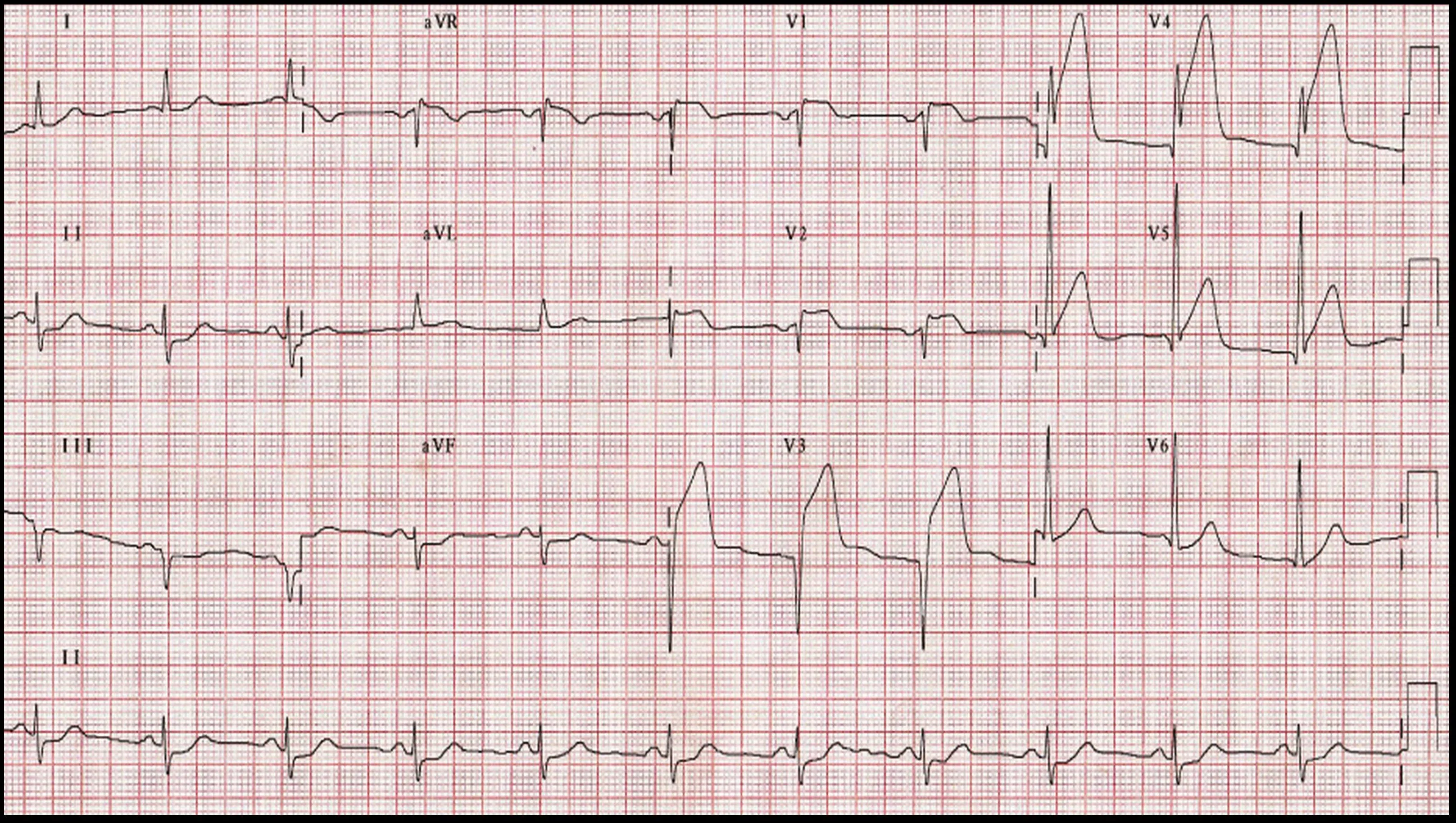 Codigo Infarto en Localización Anterior: Caso Real y Rol de Enfermería