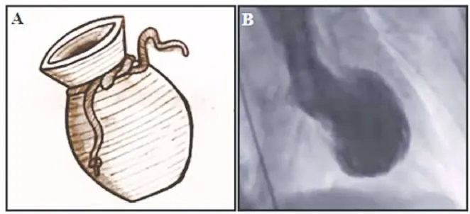 Takobsubo: el síndrome del corazón roto que imita un infarto