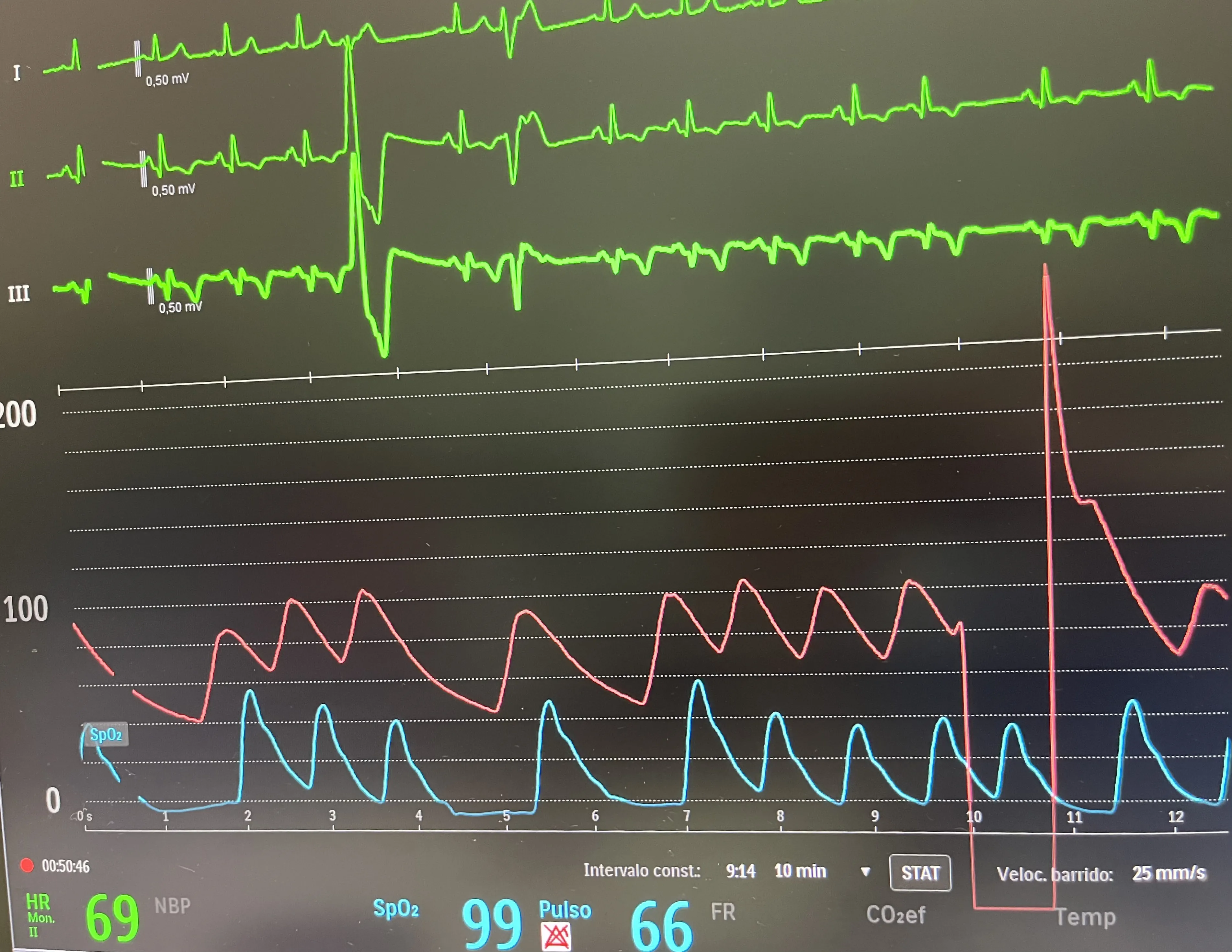 Hemodinámica cardiaca: caso real de reestenosis de stent guiada por OCT