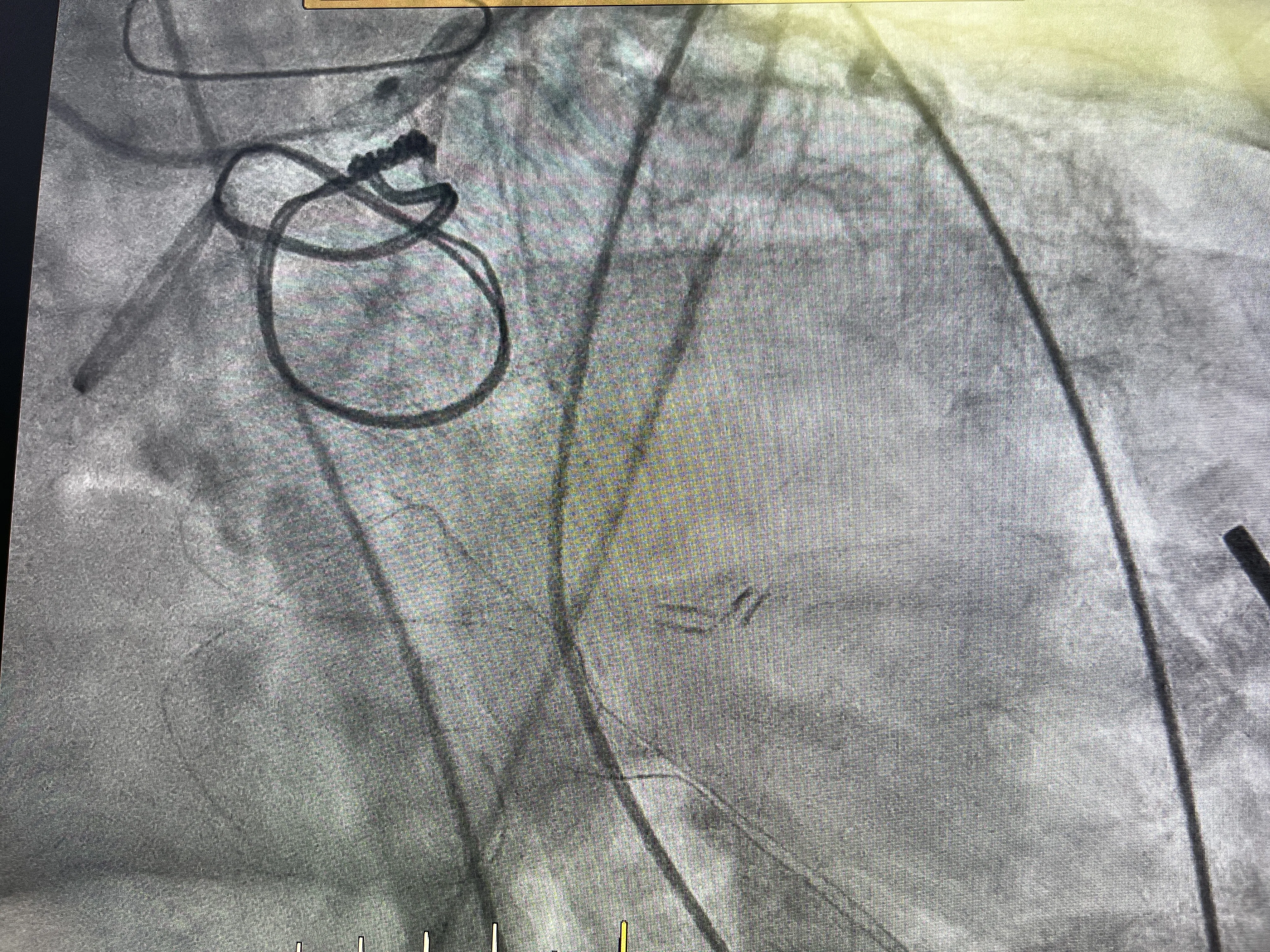 Un Caso Real de Estenosis Circunfleja: Complicaciones y Soluciones