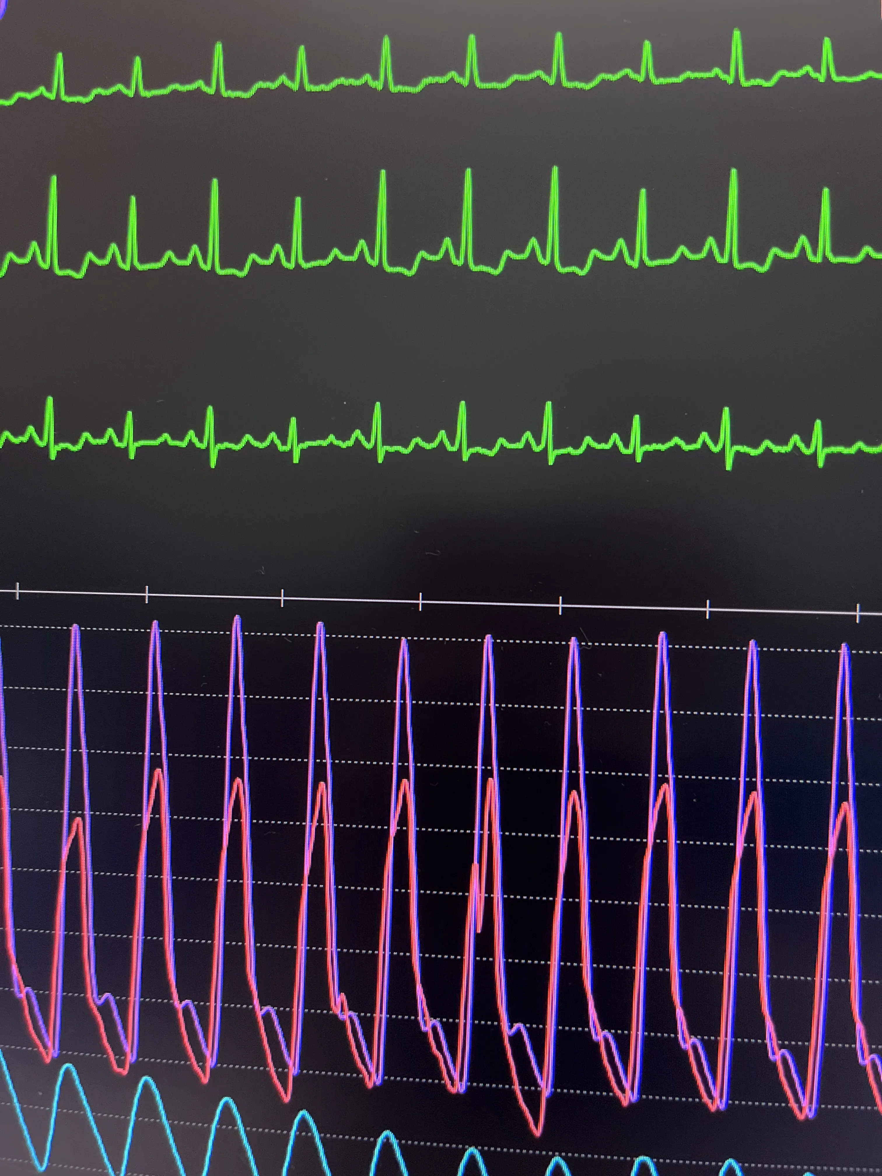 Lesión de las 3 arterias en un paciente de 90 años: manejo y decisiones