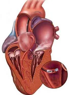 Ablación septal: cuándo se plantea y en qué consiste