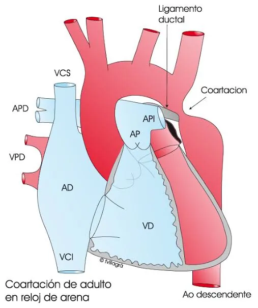 Coartación de aorta: qué es y cuándo se repara