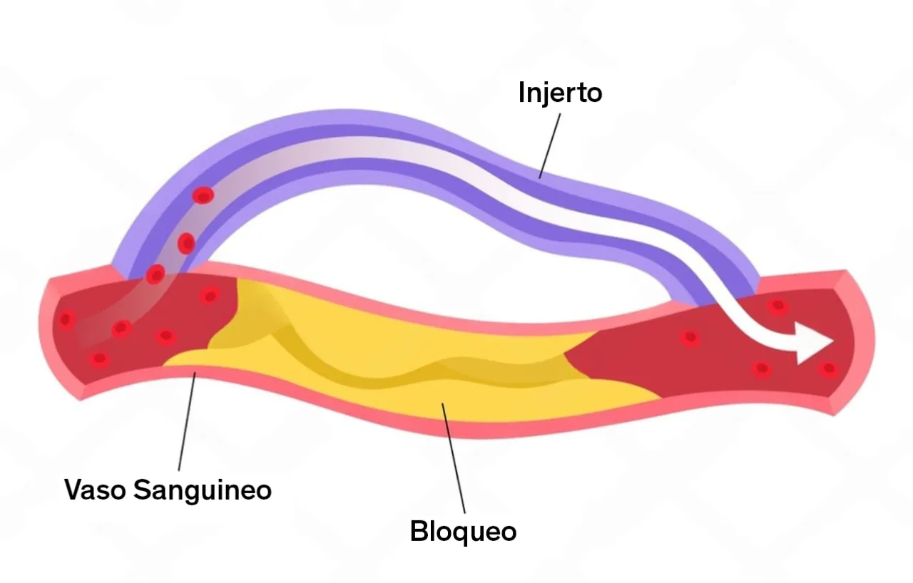 Stent o bypass: diferencias, riesgos y recuperación